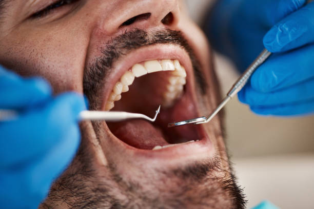 Best Emergency Wisdom Teeth Removal in Bayou La Batre, AL